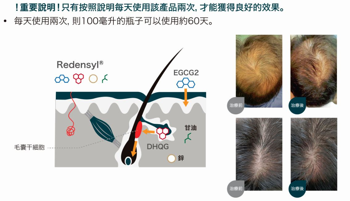 女士脫髮 生髮水